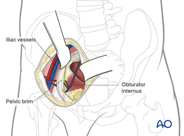Dissection of the iliopectineal arch from superior pubic ramus