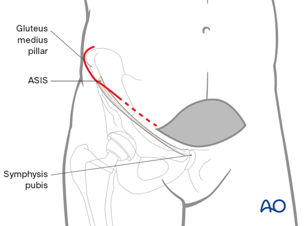 Additional lateral window in an anterior intrapelvic approach