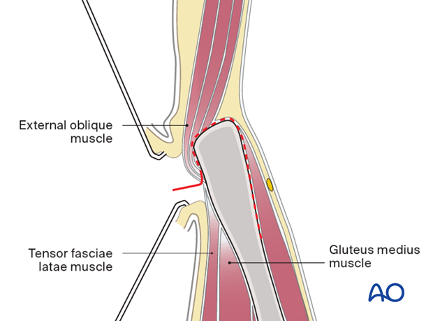 Identification of the border between the gluteus muscles and the external oblique muscles