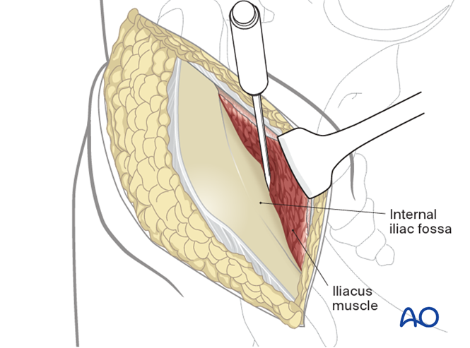 Anterior Superior Iliac Spine (ASIS) osteotomy