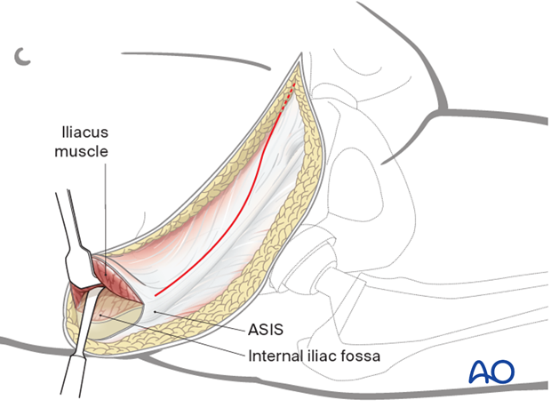 Exposure of the internal iliac fossa