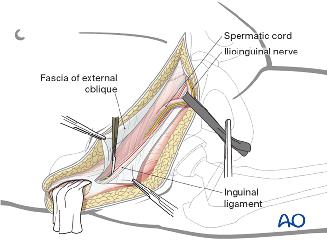 Ilioinguinal approach