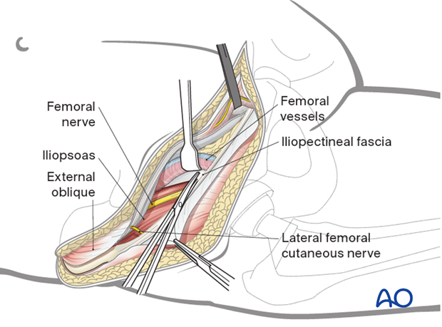 Development of the iliopectineal fascia