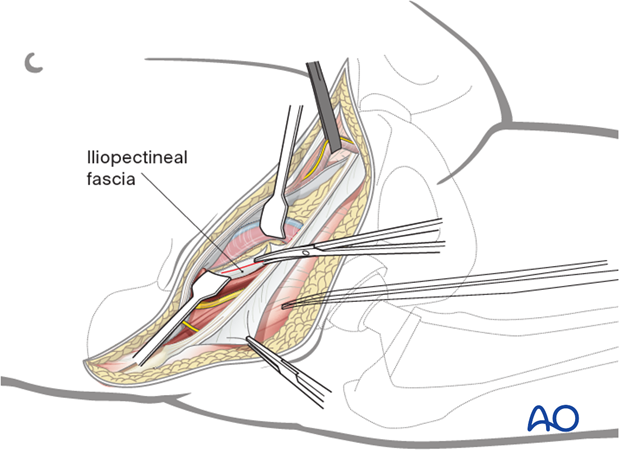 Iliopectineal fascia release