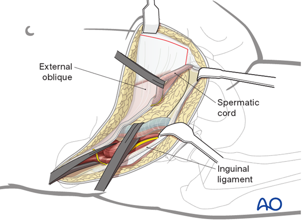 Third window for ilioinguinal approach