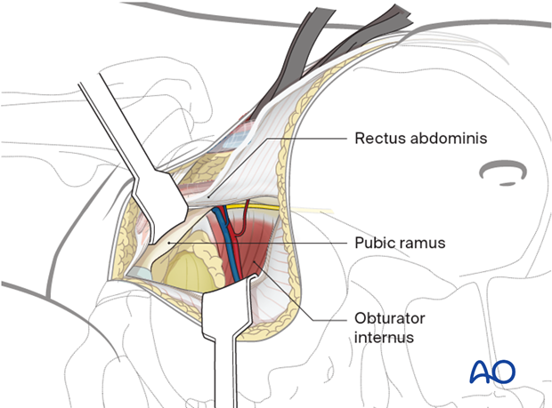 Third window modification for ilioinguinal approach