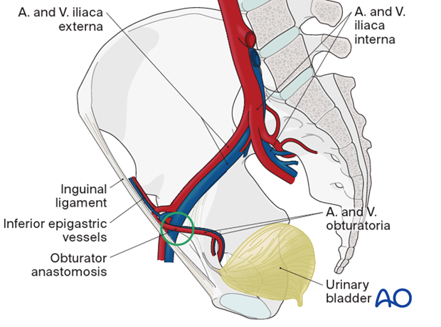 Obturator vessels anatomic variation