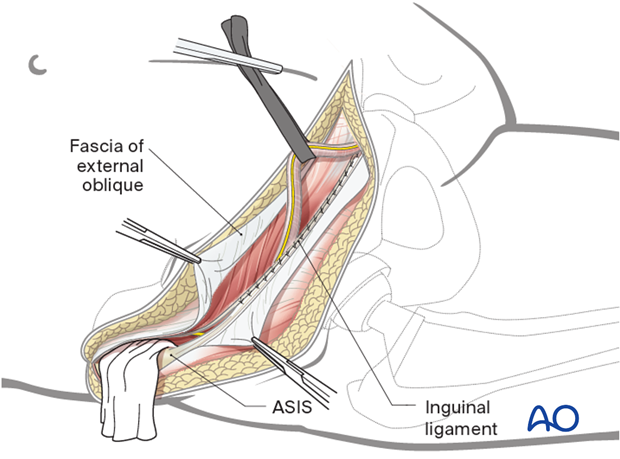 Wound closure for the ilioinguinal approach