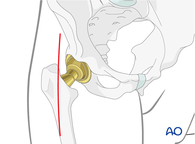 Direct anterior approach to the hip