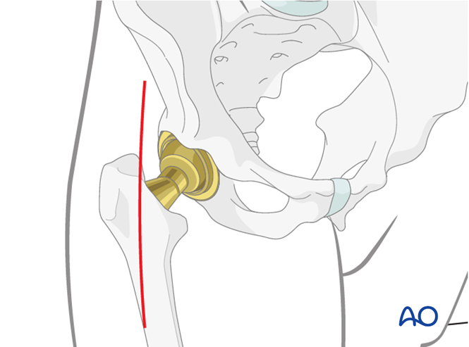 Direct Anterior Approach 8531