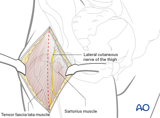 Lateral cutaneous nerve of the thigh