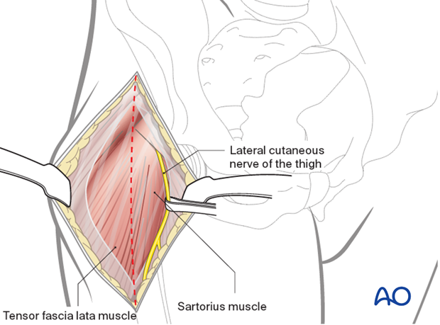 Lateral cutaneous nerve of the thigh protection