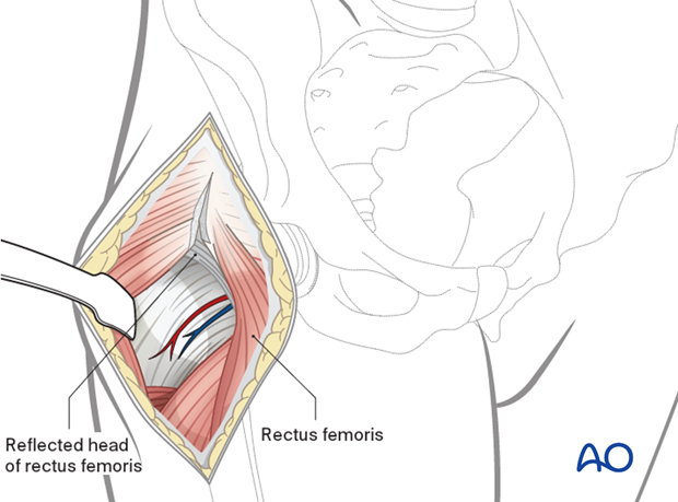 Opening of the fascia overlying the rectus