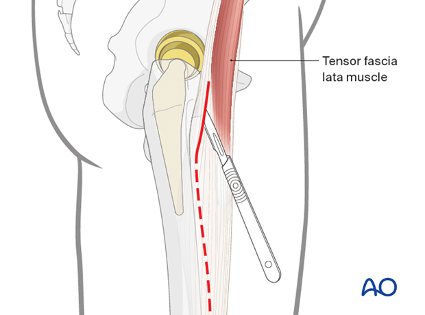 Extension for periprosthetic femoral fracture