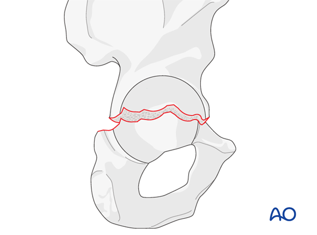Della Valle V acetabular fracture