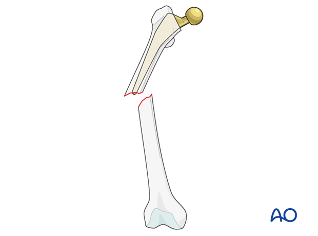 Vancouver B1 femoral fracture