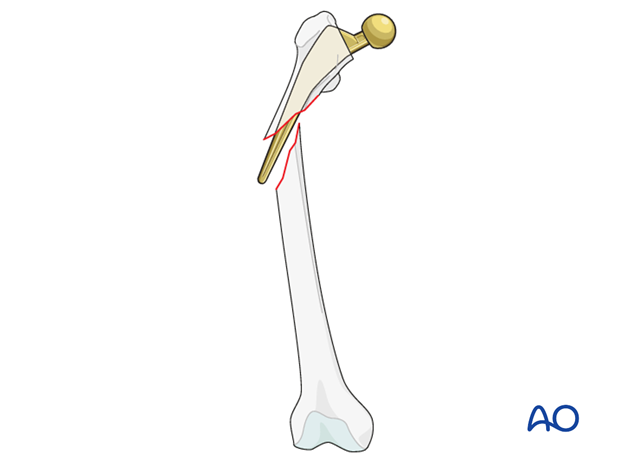 Vancouver B2 femoral fracture