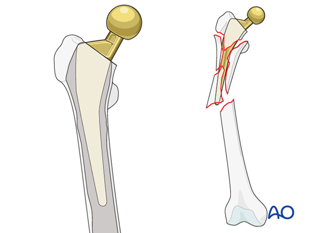 Vancouver B3 femoral fracture