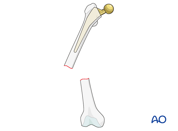 Vancouver C femoral fracture