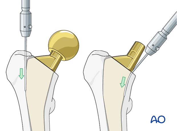 Stem removal with a flexible osteotome