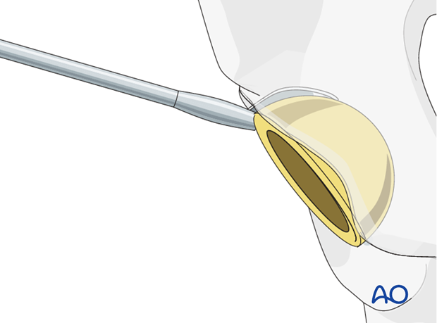 Acetabular component removal
