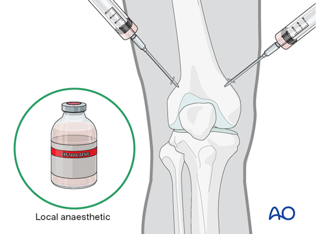 Anesthesia for distal femur pin traction