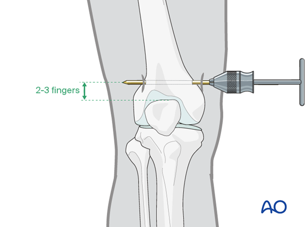 Pin insertion for distal femur traction