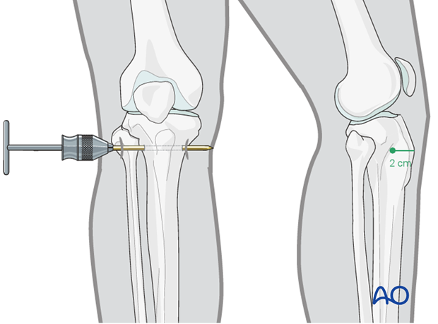 Pin insertion for tibial traction
