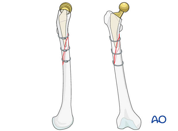 Isolated cerclage in a periprosthetic femoral fracture with a stable prosthesis