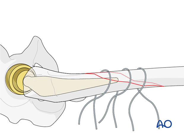 Other wires are inserted