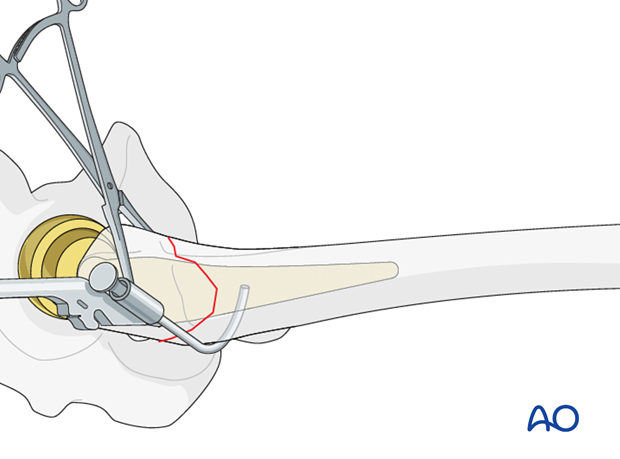 Cable/wire positioning for greater trochanteric fractures