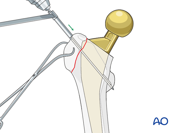 K-wire insertion for tension band to stabilize greater trochanteric periprosthetic fractures