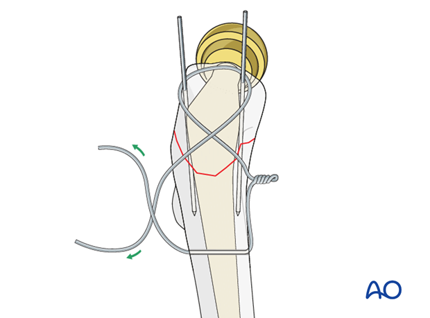 Wire positioning for tension band wiring in hip periprosthetic fractures