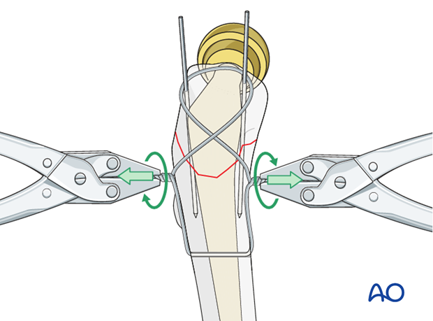 Wire tensioning for a tension band wiring in hip periprosthetic fractures