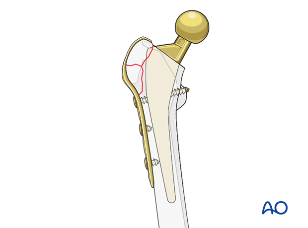Compression plate and screw fixation in a periprosthetic fracture