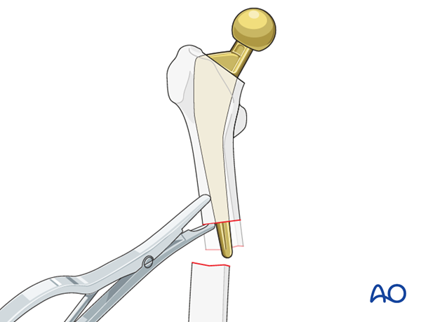 Bone is removed from the tip of the stem