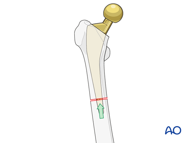 Stem inserted into the distal femoral portion