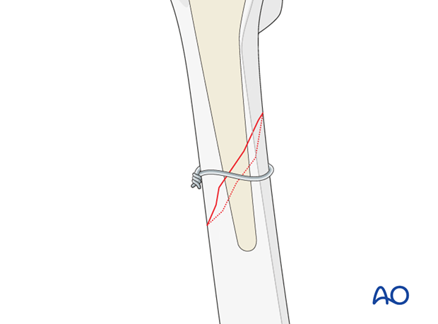 Provisional wire stabilization for short oblique fracture