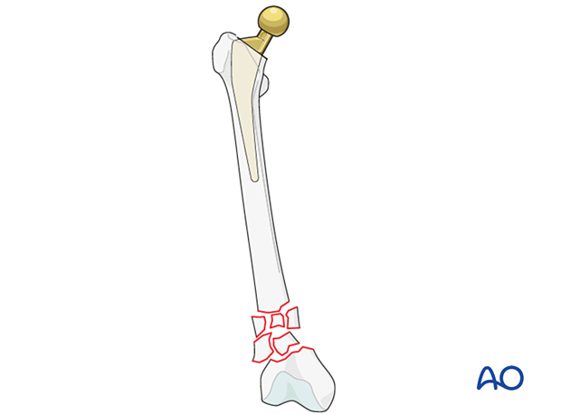 Vancouver C comminuted supracondylar fracture