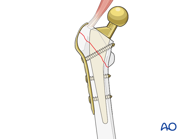 Small screw lag fixation around the femoral stem