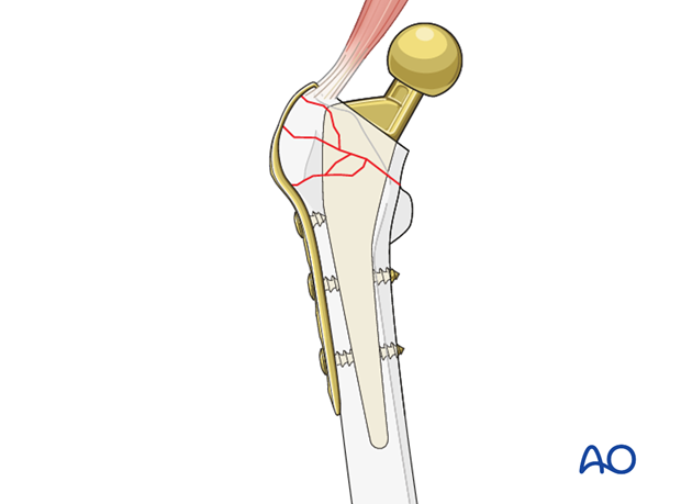 Hook plate fixation