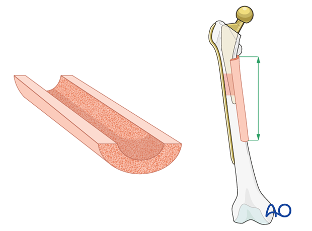 Adequate length of a strut allograft