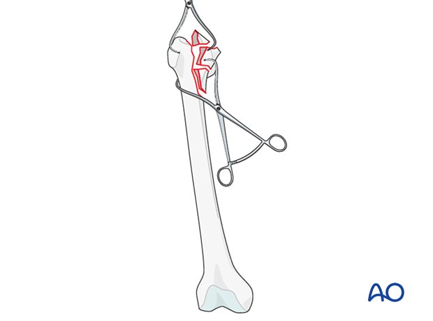 Femoral reduction
