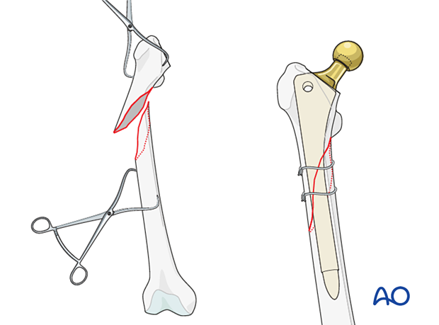 Provisional fixation of the fracture