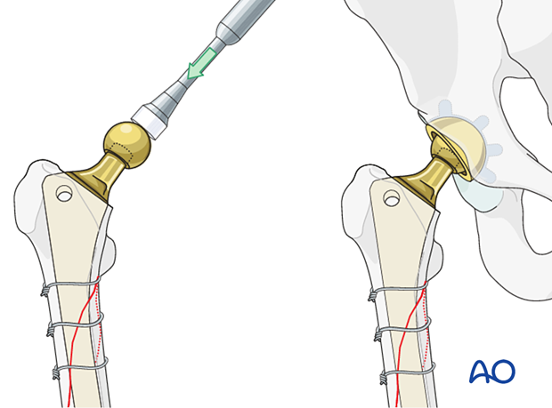 Femoral head impaction and final reduction
