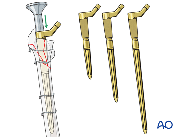 Proximal body trialing