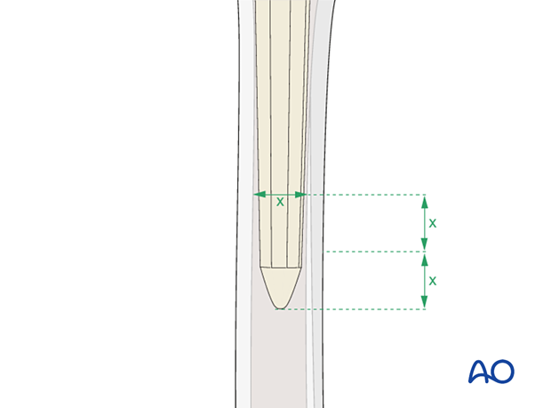 Femoral implant selection