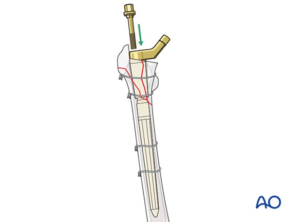 Supplemental screw/bolt insertion