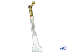 Proximal femoral replacement + cerclage