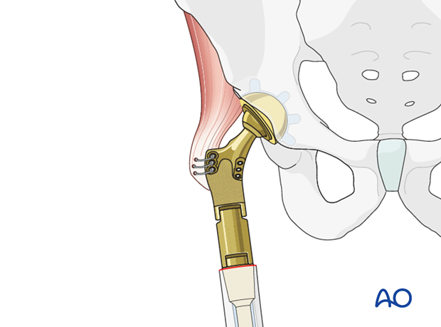 Management of the hip abductors with no bony fragment available
